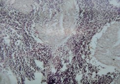 Рис. 1. Разрост лейкозными клетками <br>перифолликулярной зоны селезенки (ув. ок. 10*, об. <br>8*)