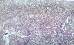 Рис. 3. Разрастание лимфатических фолликулов <br>лейкозными клетками (ув. ок. 10х, об. 8х)