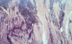 Рис. 5. Диффузные поражения миокарда лейкозными <br>клетками (ув. ок. 10*, об. 8*)