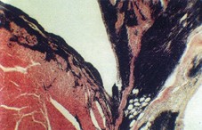 Рис. 6. Атрофия и исчезновение мышечных волокон <br>миокарда под давлением лейкозных клеток (ув. ок. <br>10*, об. 8*)