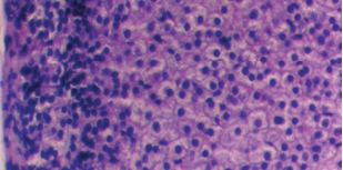 Рис. 6. Группа животных с иммуносупрессией на фоне <br>скармливания минерального адаптогена. Утолщение <br>поверхностного слоя соединительнотканной оболочки, <br>увеличение лимфоцитов в корковом слое <br>надпочечника, в мозговом слое сохраненная <br>структура органа (окраска гематоксилин и эозин, <br>*400)
