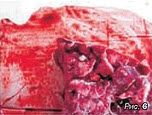 Рисунок 6. Энзоотическая пневмония, пораженная <br>часть легкого на разрезе, межлобулярный отек. <br>Гнойные пробки в бронхах 3-4 порядка.